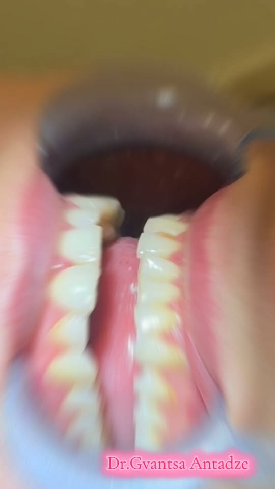 Ağzın təmizlənməsi və ağartılması haqqında 🦷