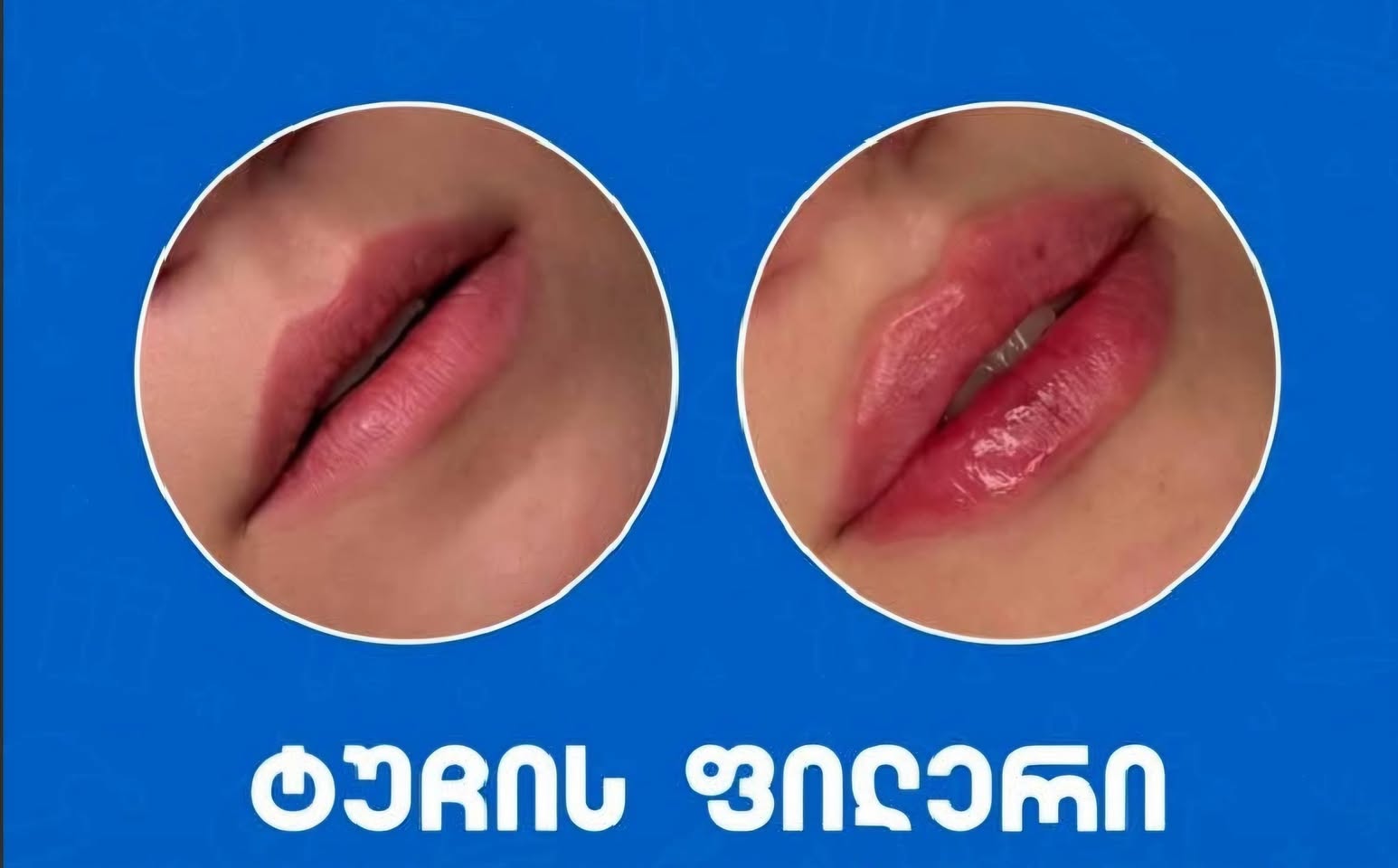 💥📣💥📣 Ա Հ Ց Ո Ւ Մ👉ներարկումներ💃գայլամազի վրա